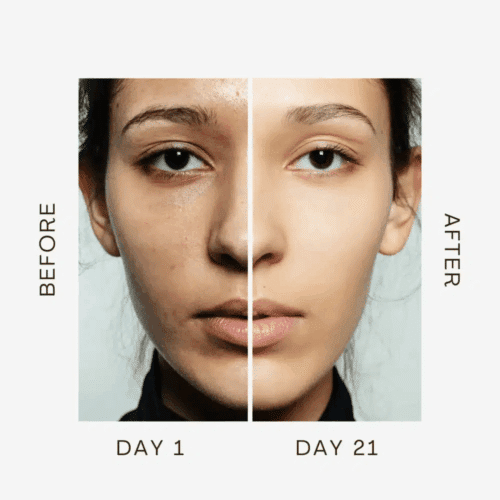 RenewaLift Before and After